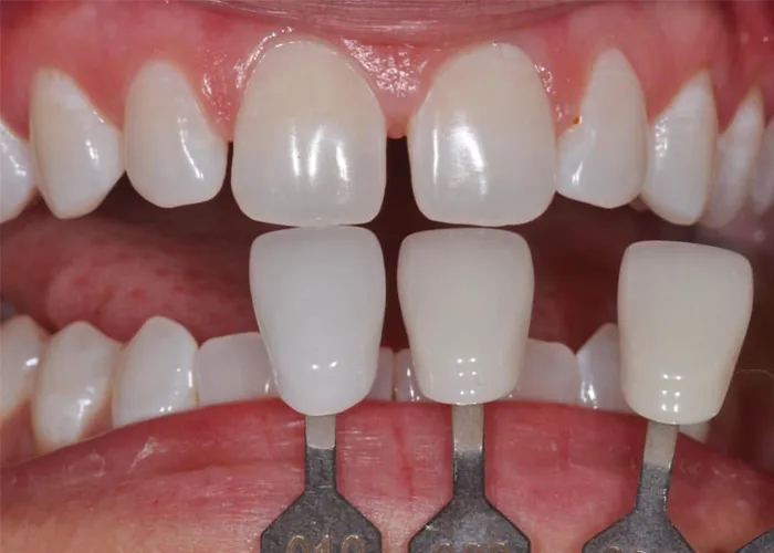 Image1-UT Multilayer Zirconia Disc